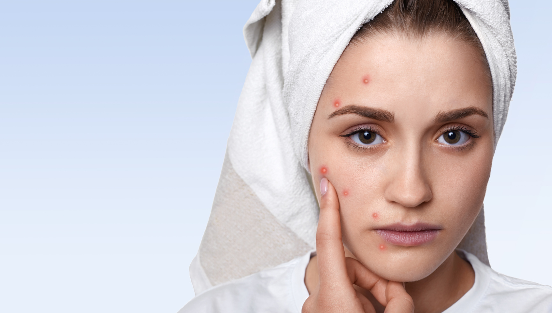 Acne e imperfezioni: tutto quello che c’è da sapere