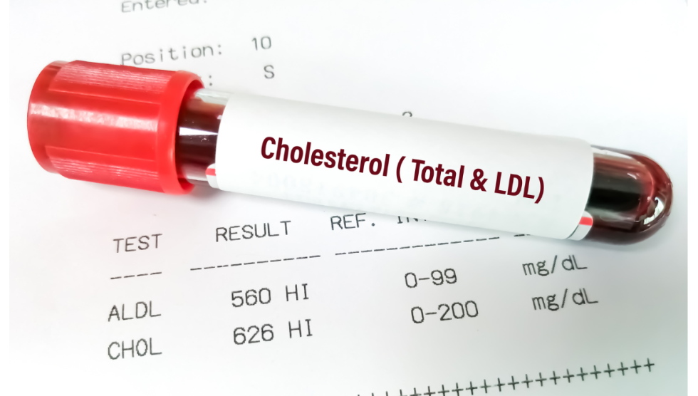 colesterolo: come riconoscerlo, controllarlo e prevenirne gli effetti