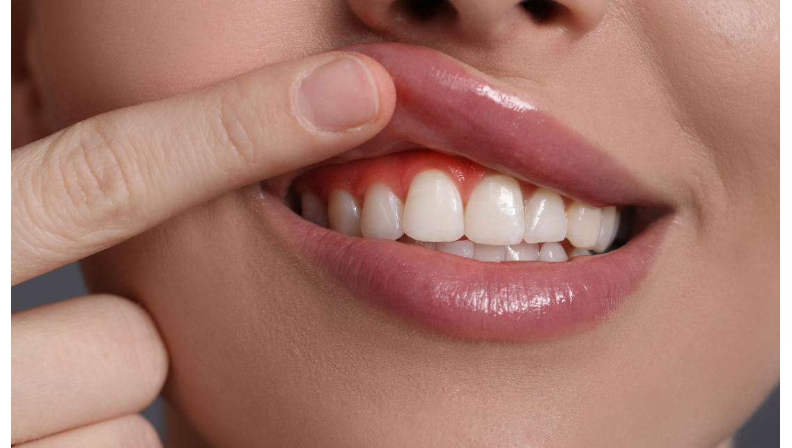 Gengive arrossate: cause, rimedi e come trattarle