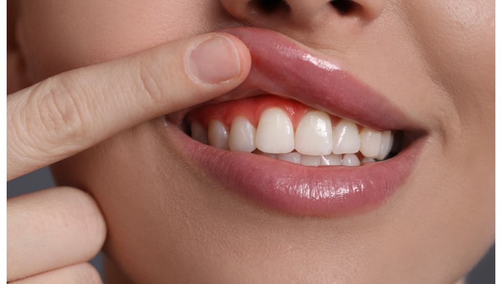 Gengive arrossate: cause, rimedi e come trattarle