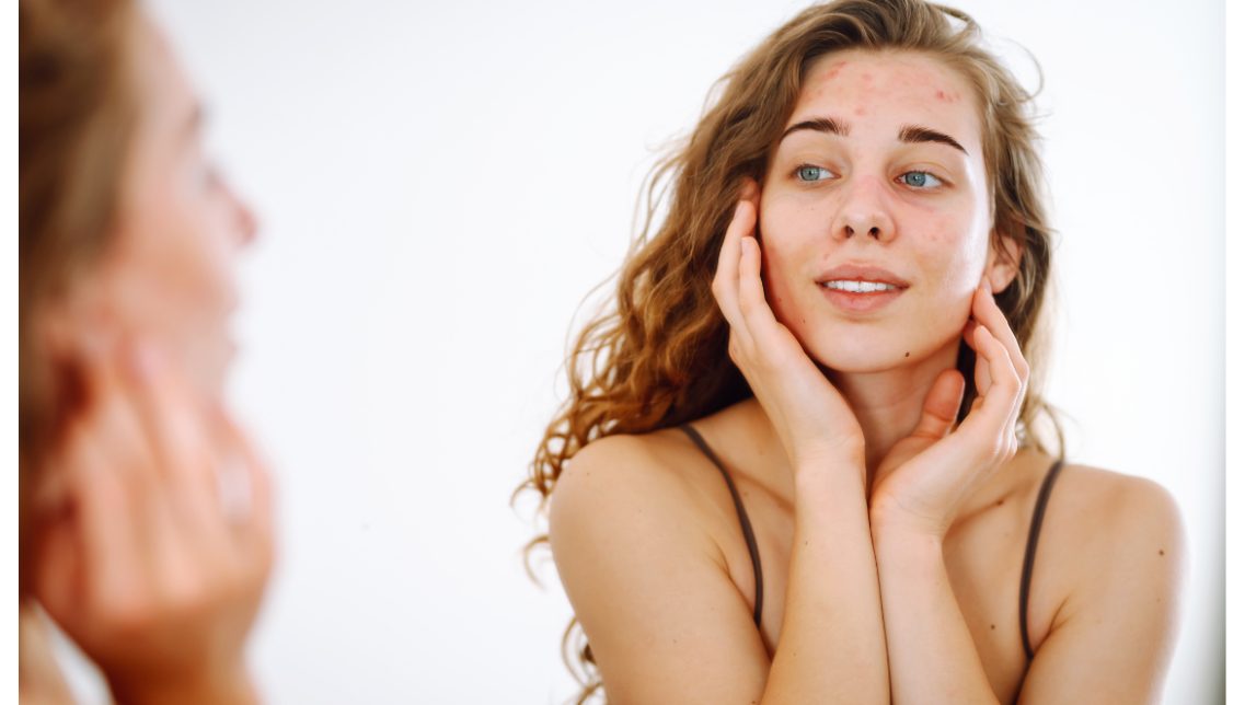 Pelle secca e screpolata: routine completa per proteggerla in inverno Pelle secca e screpolata: routine completa per proteggerla in inverno